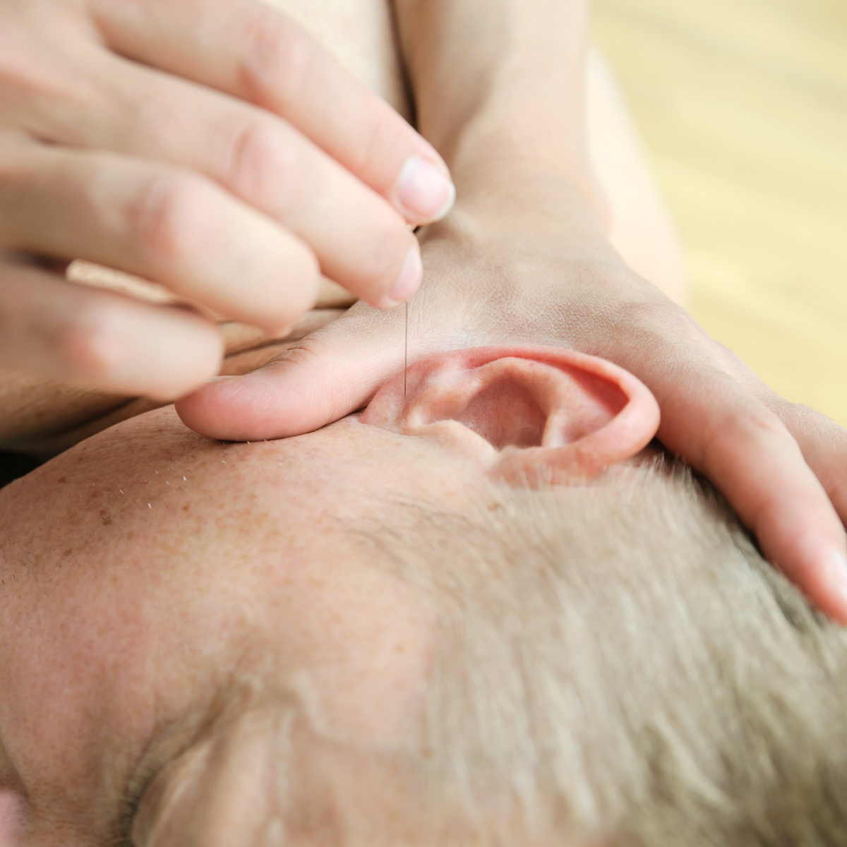 Auricular Acupuncture​